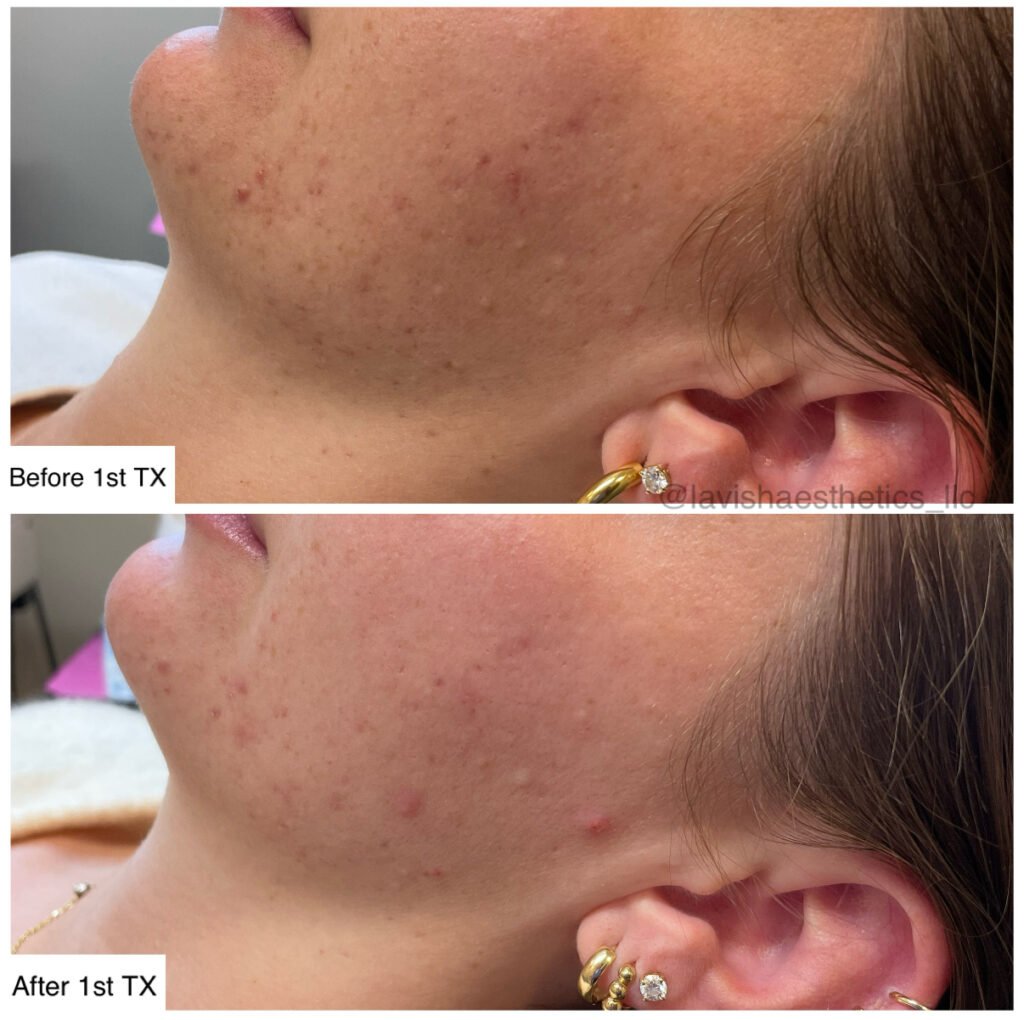 microchanneling before and after result