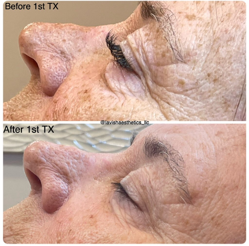 microchanneling before and after result