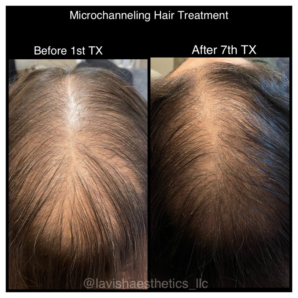 microchanneling before and after result